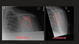 Posterior Shoulder Dislocation Reduction [upl. by Chaiken400]