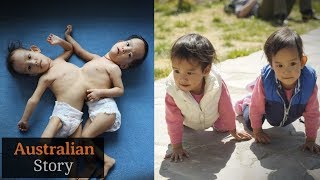 Two Heads One Body The Remarkable Story of Conjoined Twins Katie amp Eilish  Our Life [upl. by Enoob]