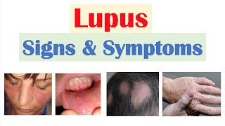 Systemic Lupus Erythematosus SLE  MedicalSurgical Immune  LevelUpRN [upl. by Atlee]