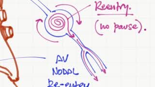 Taquicardia supraventricular vs ventricular [upl. by Ynaittirb]