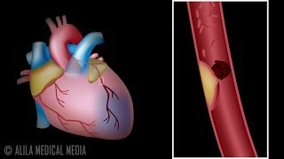 Myocardial Infarction and Coronary Angioplasty Treatment Animation [upl. by Draner]