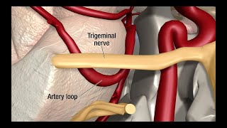 Treatment for Trigeminal Neuralgia UCSF Neurosurgery [upl. by Annibo]