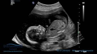 14 Week Pregnancy Ultrasound  Baby Moving and Yawning [upl. by Jung]