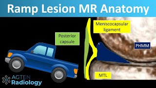 Ramp Lesions on Knee MRI Anatomy [upl. by Ahsilahs]