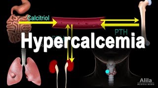 Hypercalcemia  Too Much Calcium Animation [upl. by Oni]