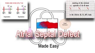 Life after Atrial Septal Defect Closure [upl. by Giulietta395]