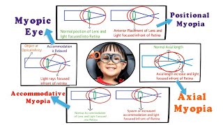 Myopia  Introduction and Etiology within 3 min 15 [upl. by Gilberta240]