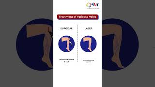 Treatment Of Varicose Veins  Surgery VS Laser  वैरिकोज वेन्स [upl. by Fevre]