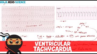 Rate and Rhythm  Ventricular Tachycardia [upl. by Trinl]