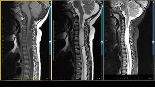 Spinal Cord Injury  diagnosis treatment recovery [upl. by Loeb181]