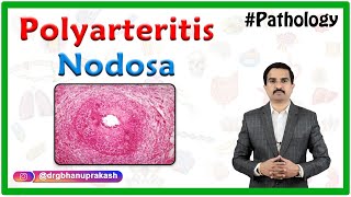 Polyarteritis nodosa  Definition Epidemiology Pathology Clinical features Diagnosis Treatment [upl. by Snoddy534]