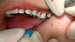 Gracey Instrumentation During Periodontal Therapy [upl. by Fosque]