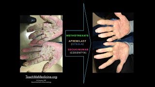 Apremilast Otezla SecukinumabCosentyx Methotrexate and Keratoderma [upl. by Sine]