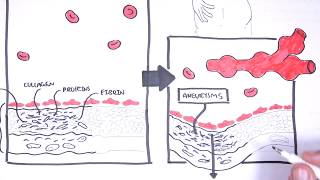 Polyarteritis Nodosa and Kawasaki Disease Medium Vessel Vasculitis  Symptoms pathophysiology [upl. by Gamal]