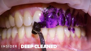 How Teeth Are Professionally Deep Cleaned  Deep Cleaned [upl. by Urina878]