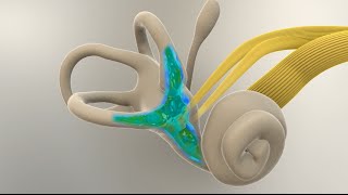 Menieres Disease  What Happens in the Inner Ear [upl. by Bucher]