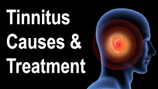 What is Tinnitus Causes amp Treatment Strategies [upl. by Attalie]