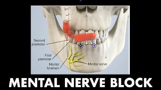 3B  Mental Nerve Block Dr Demetrick LeCorn [upl. by Shepley166]