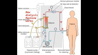 Hemodialysis Access 101 03  Physical Exam of AVF [upl. by Filipe920]