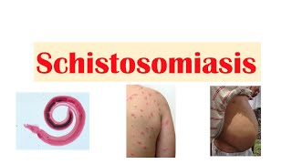 Schistosomiasis  Bilharziasis  Causes Symptoms and Treatment [upl. by Pernell]