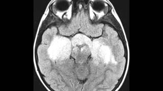 Optic Pathway Glioma [upl. by Mike]