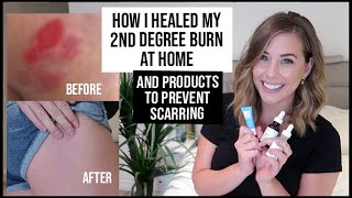 How I Healed My Burn Scar  Prevent A Burn From Scarring  xameliax [upl. by Margalo579]