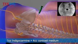 Treatment of herniated disc with TESSYS method lateral  BandscheibenOP mit TESSYSMethode lateral [upl. by Benjie]