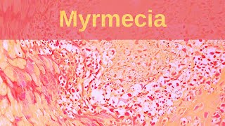 Deep Palmoplantar Wart Myrmecia  Pathology mini tutorial [upl. by Christoper459]