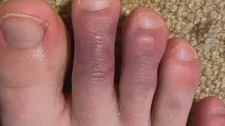 What are COVID toes [upl. by Seraphina]