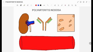 POLYARTERITIS NODOSA [upl. by Kramnhoj]