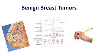 Benign Breast Conditions  USMLE COMLEX NCLEX [upl. by Anitnerolf995]