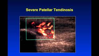 Introduction to Musculoskeletal Ultrasound [upl. by Tamar]