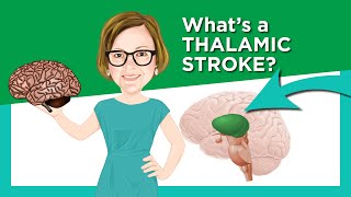 Thalamic Stroke [upl. by Ahsercel229]