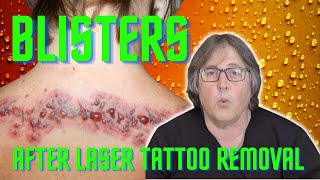 Blisters After Laser Tattoo Removal Why And How To Treat Them [upl. by Emrich306]