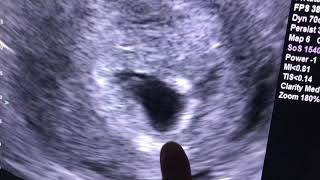 Sonogram 6 weeks pregnant [upl. by Ainahs868]