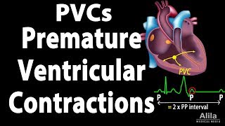 Premature Ventricular Contractions PVCs Animation [upl. by Hairom]