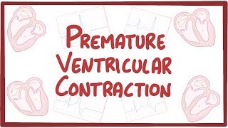 Premature Ventricular Contraction  causes symptoms diagnosis treatment pathology [upl. by Steffane630]