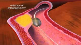 Transradial Femoral Artery Atherectomy and Angioplasty [upl. by Abdel159]