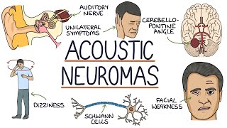 Understanding Acoustic Neuromas [upl. by Noll34]