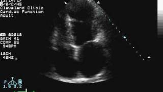 Apical Wall Motion Abnormality [upl. by Atteynek326]