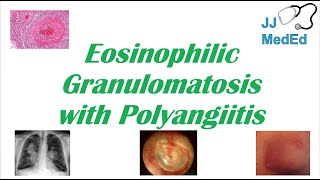 Eosinophilic Granulomatosis with Polyangiitis EGPA  ChurgStrauss Syndrome Autoimmune Vasculitis [upl. by Cowden]