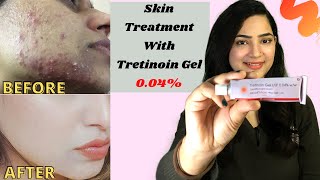 TRETINOIN Gel 004 Review Before And After Tretinoin Cream Review  RetinoA review myexperience [upl. by Morganica]