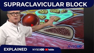 Supraclavicular Block  Regional anesthesia Crash course with Dr Hadzic [upl. by Meter]