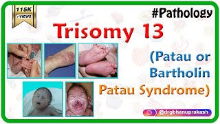 Trisomy 13 Patau or BartholinPatau syndrome  Causes  Diagnosis  Treatment [upl. by Gusti17]