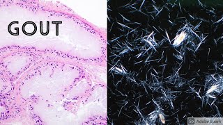 GOUT Under the Microscope Brilliant Polarizable Birefringent Monosodium Urate Crystals [upl. by Bekaj242]