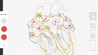 Cardiología y ECG Taquicardias supraventriculares vs ventriculares [upl. by Adiuqal]