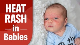 Heat Rash in Babies [upl. by Netta20]