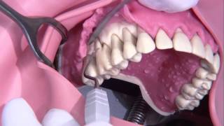 Periodontal surgery Modified Widmann flap [upl. by Enilrad]