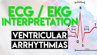 Ventricular Arrhythmias  ECG EKG Interpretation Part 5 [upl. by Rakia684]