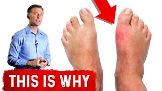 Why Do You Get Gout in Your Big Toe [upl. by Saire]